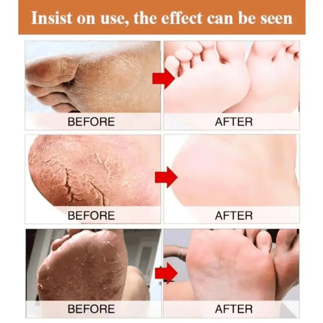 Foot Cream for Cracked Heels